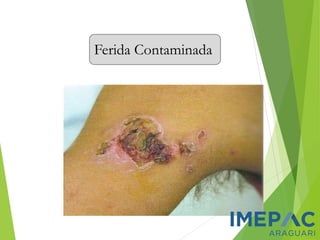 Ferida Contaminada
 