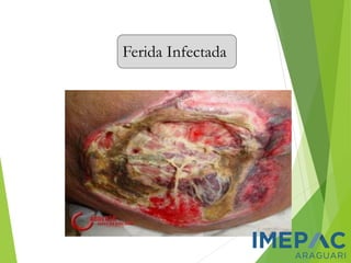 Ferida Infectada
 