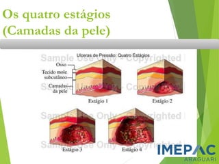 Os quatro estágios
(Camadas da pele)
 