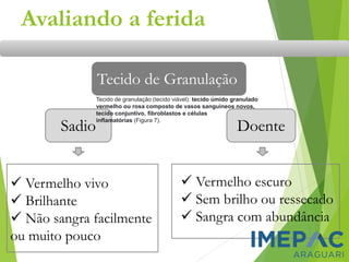 Avaliando a ferida
Sadio Doente
Tecido de Granulação
✓ Vermelho vivo
✓ Brilhante
✓ Não sangra facilmente
ou muito pouco
✓ Vermelho escuro
✓ Sem brilho ou ressecado
✓ Sangra com abundância
Tecido de granulação (tecido viável): tecido úmido granulado
vermelho ou rosa composto de vasos sanguíneos novos,
tecido conjuntivo, fibroblastos e células
inflamatórias (Figura 7).
 