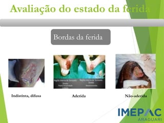 Avaliação do estado da ferida
Bordas da ferida
Indistinta, difusa Aderida Não-aderida
 