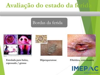 Avaliação do estado da ferida
Bordas da ferida
Enrolada para baixo,
espessada / grossa
Hiperqueratose Fibrótica, com cicatriz
 
