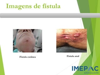 Imagens de fístula
Fístula cutânea Fístula anal
 