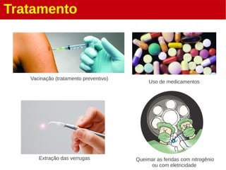 Tratamento
Vacinação (tratamento preventivo)
Uso de medicamentos
Extração das verrugas Queimar as feridas com nitrogênio
ou com eletricidade
 
