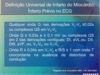 Definição Universal de Infarto do Miocárdio:  I nfarto Prévio no ECG Qualquer onda Q nas derivações  V 2 -V 3  ≥0,02s ou complexos QS em  V 2 -V 3 Onda Q ≥ 0,03s e ≥ 0,1 mV ou complexos QS em 2 das derivações contíguas: DI, aVL,ou, DII, DIII, aVF, ou, V 4 -V 6 , ou V 7 -V 9 Onda R ≥ 0,04s em V 1 -V 2  e R/S ≥ 1 com onda T concordante na ausência de distúrbios de condução Thygesen et al. Circulation 2007; 116: 2634-2653 