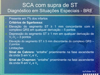 SCA com supra de ST Diagnóstico em Situações Especiais - BRE Presente em 7% dos infartos Critérios de Sgarbossa: Elevação do segmento ST  ≥ 1 mm concordante com o complexo QRS em qualquer derivação – 5 pontos Depressão do segmento ST ≥ 1 mm em qualquer derivação de V 1 -V 3  – 3 pontos Elevação do segmento ST ≥ 5 mm discordante do complexo QRS – 2 pontos Limitações Sinal de Cabrera:  “entalhe” proeminente na fase ascendente da onda S em V 3  e V 4 Sinal de Chapman:  “entalhe” proeminente na fase ascendente da onda R em V 5  e V 6 UpToDate 15.3 