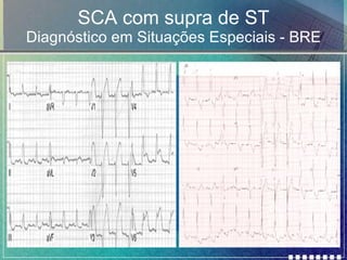 SCA com supra de ST Diagnóstico em Situações Especiais - BRE 
