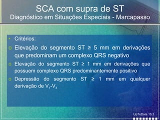 SCA com supra de ST Diagnóstico em Situações Especiais - Marcapasso Critérios: Elevação do segmento ST  ≥ 5 mm em derivações que predominam um complexo QRS negativo Elevação do segmento ST ≥ 1 mm em derivações que possuem complexo QRS predominantemente positivo Depressão do segmento ST ≥ 1 mm em qualquer derivação de V 1 -V 3 UpToDate 15.3 