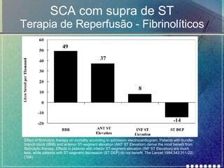 SCA com supra de ST Terapia de Reperfusão - Fibrinolíticos Effect of fibrinolytic therapy on mortality according to admission electrocardiogram. Patients with bundle-branch block (BBB) and anterior ST-segment elevation (ANT ST Elevation) derive the most benefit from fibrinolytic therapy. Effects in patients with inferior ST-segment elevation (INF ST Elevation) are much less, while patients with ST-segment depression (ST DEP) do not benefit. The Lancet 1994;343:311-22) (156). 