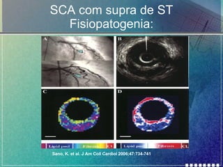 SCA com supra de ST Fisiopatogenia: Sano, K. et al. J Am Coll Cardiol 2006;47:734-741 