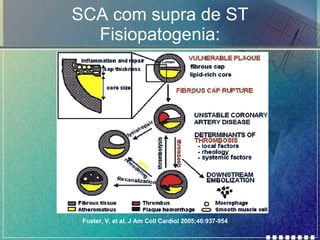 SCA com supra de ST Fisiopatogenia: Fuster, V. et al. J Am Coll Cardiol 2005;46:937-954 