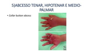 Aula - Infecções da Mão [Autosaved].pptx