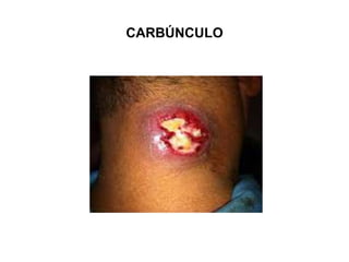 CARBÚNCULO
 