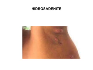 HIDROSADENITE
 
