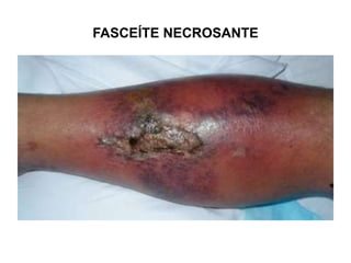FASCEÍTE NECROSANTE
 