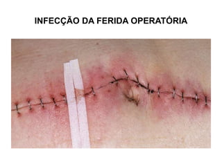 INFECÇÃO DA FERIDA OPERATÓRIA
 