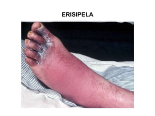 ERISIPELA
 