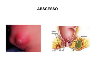 ABSCESSO
 