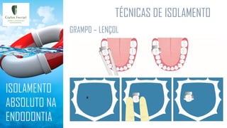 TÉCNICAS DE ISOLAMENTO
ISOLAMENTO
ABSOLUTO NA
ENDODONTIA
GRAMPO – LENÇOL
 