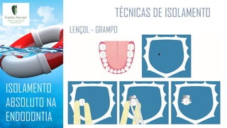 TÉCNICAS DE ISOLAMENTO
ISOLAMENTO
ABSOLUTO NA
ENDODONTIA
LENÇOL - GRAMPO
 