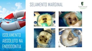 SELAMENTO MARGINAL
ISOLAMENTO
ABSOLUTO NA
ENDODONTIA
 