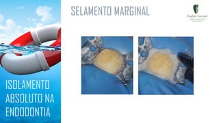 SELAMENTO MARGINAL
ISOLAMENTO
ABSOLUTO NA
ENDODONTIA
 