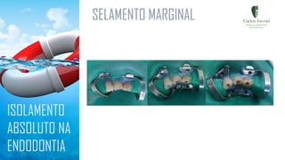 SELAMENTO MARGINAL
ISOLAMENTO
ABSOLUTO NA
ENDODONTIA
 