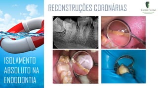 RECONSTRUÇÕES CORONÁRIAS
ISOLAMENTO
ABSOLUTO NA
ENDODONTIA
 