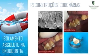 RECONSTRUÇÕES CORONÁRIAS
ISOLAMENTO
ABSOLUTO NA
ENDODONTIA
 