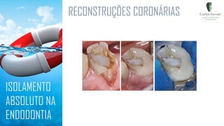RECONSTRUÇÕES CORONÁRIAS
ISOLAMENTO
ABSOLUTO NA
ENDODONTIA
 