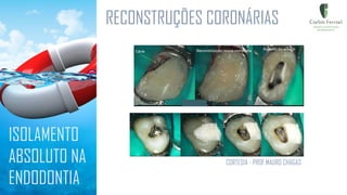 RECONSTRUÇÕES CORONÁRIAS
ISOLAMENTO
ABSOLUTO NA
ENDODONTIA
CORTESIA - PROF.MAURO CHAGAS
 