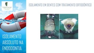 ISOLAMENTO EM DENTES COM TRATAMENTO ORTODÔNTICO
ISOLAMENTO
ABSOLUTO NA
ENDODONTIA
 