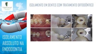 ISOLAMENTO EM DENTES COM TRATAMENTO ORTODÔNTICO
ISOLAMENTO
ABSOLUTO NA
ENDODONTIA
 