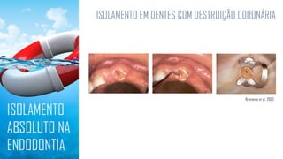 ISOLAMENTO EM DENTES COM DESTRUIÇÃO CORONÁRIA
ISOLAMENTO
ABSOLUTO NA
ENDODONTIA
Bramante et al., 2003
 