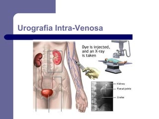 Urografia Intra-Venosa

 