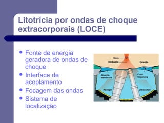 Litotrícia por ondas de choque
extracorporais (LOCE)
 Fonte

de energia
geradora de ondas de
choque
 Interface de
acoplamento
 Focagem das ondas
 Sistema de
localização

 