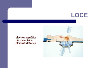 LOCE

electromagnética
piezoelectrica
electrohidráulica

 