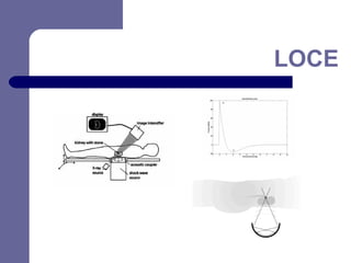 LOCE

 
