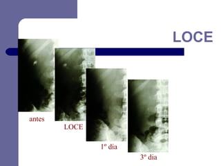 LOCE

antes

LOCE
1º dia
3º dia

 