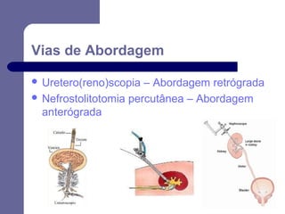 Vias de Abordagem
 Uretero(reno)scopia

– Abordagem retrógrada
 Nefrostolitotomia percutânea – Abordagem
anterógrada

 