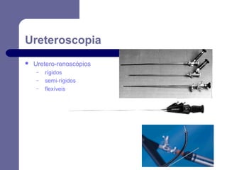 Ureteroscopia


Uretero-renoscópios
–
–
–

rígidos
semi-rígidos
flexíveis

 
