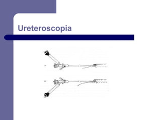 Ureteroscopia

 