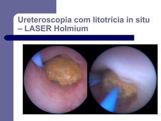 Ureteroscopia com litotrícia in situ
– LASER Holmium

 