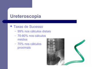 Ureteroscopia
 Taxas
–
–
–

de Sucesso

99% nos cálculos distais
70-80% nos cálculos
médios
70% nos cálculos
proximais

 