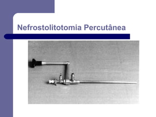 Nefrostolitotomia Percutânea

 