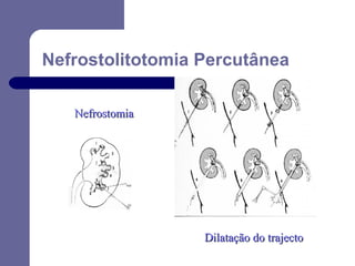 Nefrostolitotomia Percutânea
Nefrostomia

Dilatação do trajecto

 
