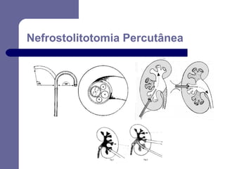 Nefrostolitotomia Percutânea

 