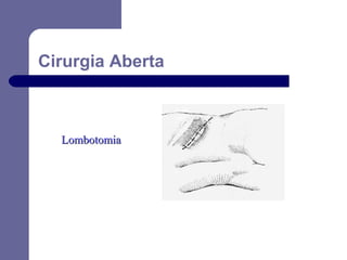 Cirurgia Aberta

Lombotomia

 