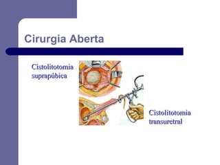 Cirurgia Aberta
Cistolitotomia
suprapúbica

Cistolitotomia
transuretral

 