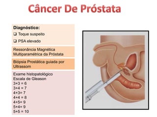 Diagnóstico:
 Toque suspeito
 PSA elevado
Ressonância Magnética
Multiparamétrica da Próstata
Exame histopatológico
Escala de Gleason
3+3 = 6
3+4 = 7
4+3= 7
4+4 = 8
4+5= 9
5+4= 9
5+5 = 10
Biópsia Prostática guiada por
Ultrassom
 
